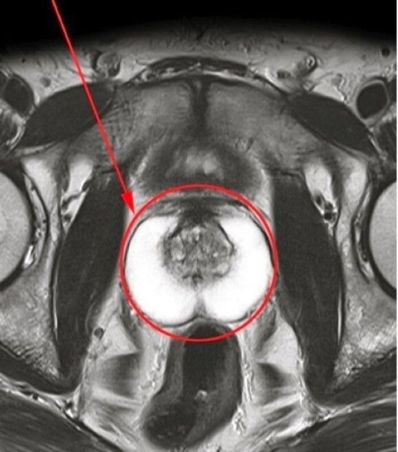 Foto della prostata dopo l'uso delle capsule Predstonorm