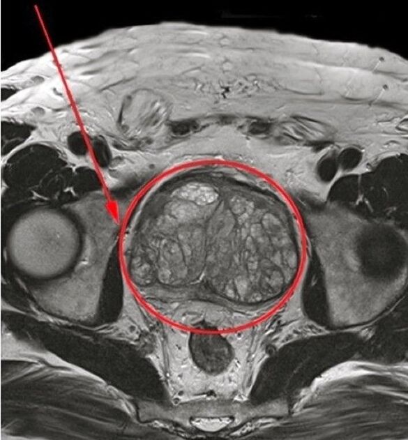 Immagine della prostata per l'uso delle capsule Predstonorm