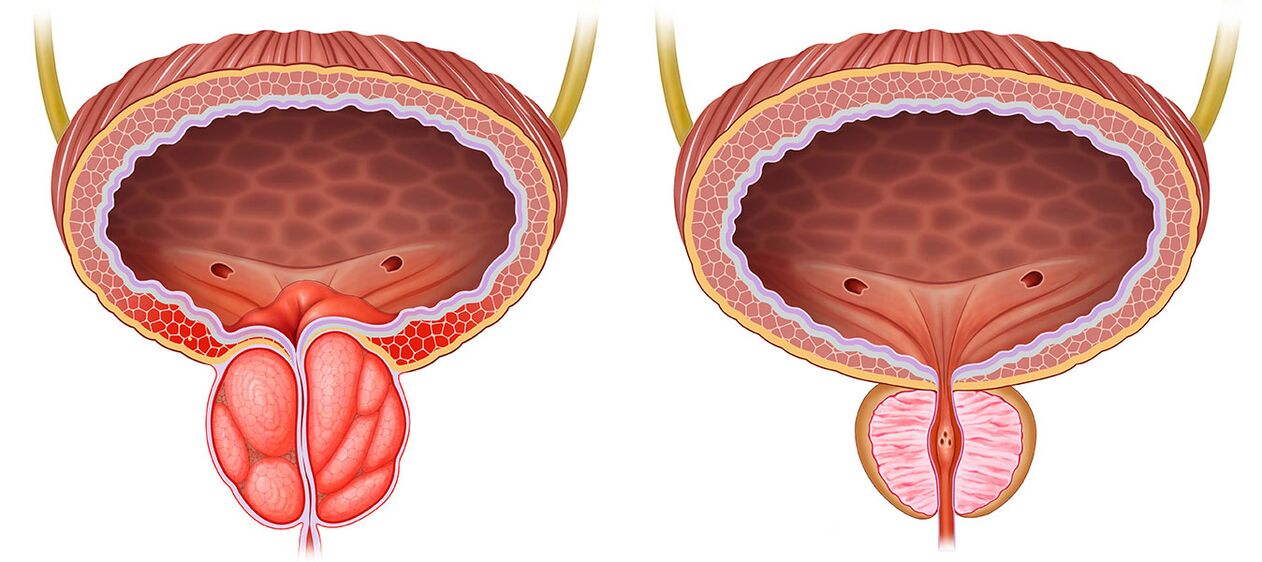 Prostata infiammata e sana dopo aver usato le capsule di Predstonorm