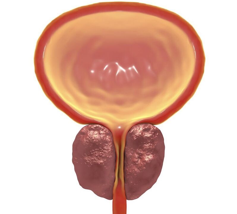Infiammazione della prostatite cronica