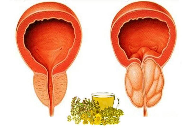 Prostata sana e dolorante