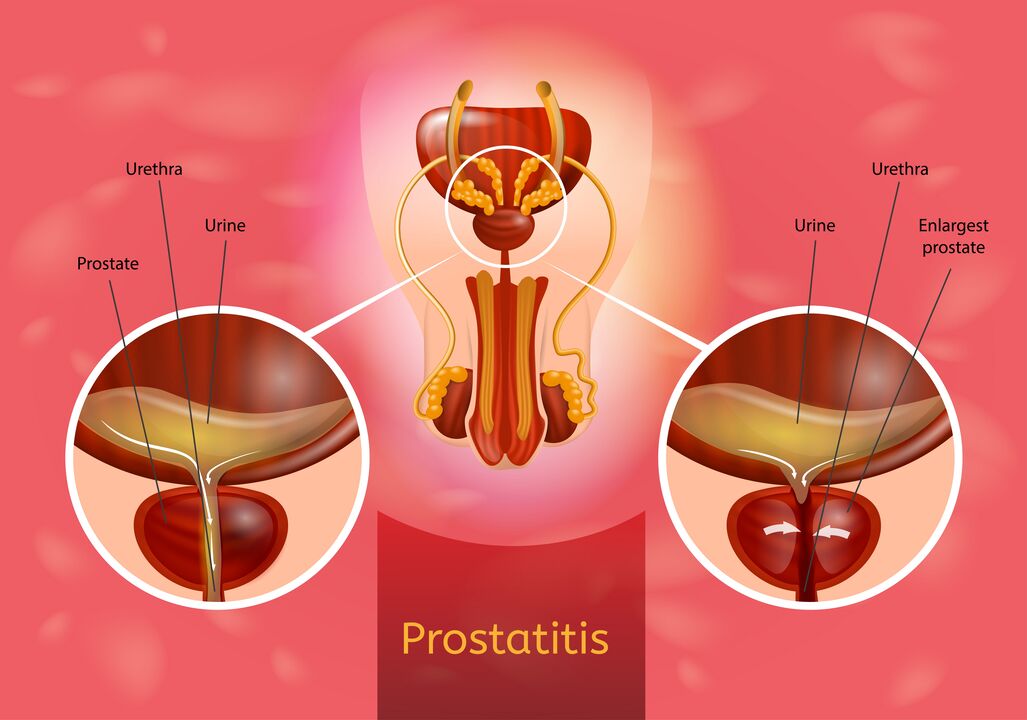 Prostata