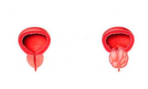 prostata sana e infiammata con prostatite